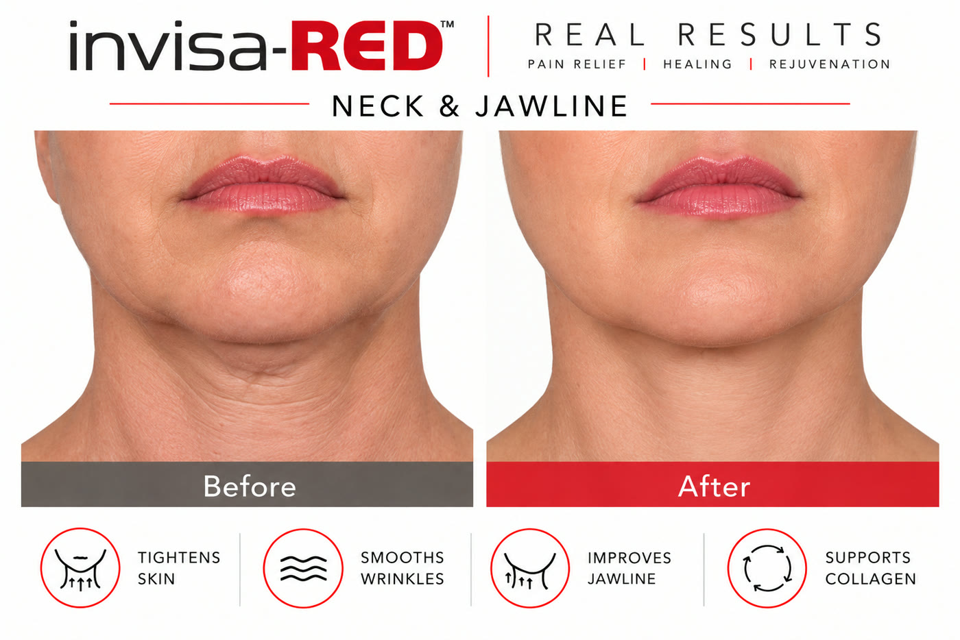 InvisaRED before and after: neck and jawline showing tighter skin and a more defined jawline